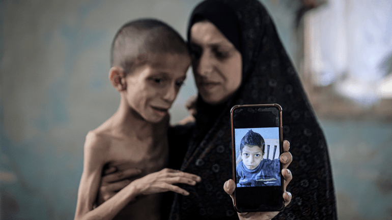 أبرز الصور في أسبوع.. غزة تحت حصار الموت ومظاهرات العالم تفضح التجويع 7 GAZA CITY, GAZA - AUGUST 05: 10-year-old Nafez Mohammed Khidr Nasser struggles with serious health issues due to malnutrition and brain atrophy in Gaza City, Gaza on August 05, 2025. His weight has dropped rapidly, and he has lost the ability to walk. Nafez and his family are living under harsh conditions in the Tuffah neighborhood, lacking basic food and medicine. With his health in critical condition, Nafez is seeking treatment abroad. Photojournalist:Ahmed Jihad Ibrahim Al-arini Publisher:Pınar Şebnem Gürel