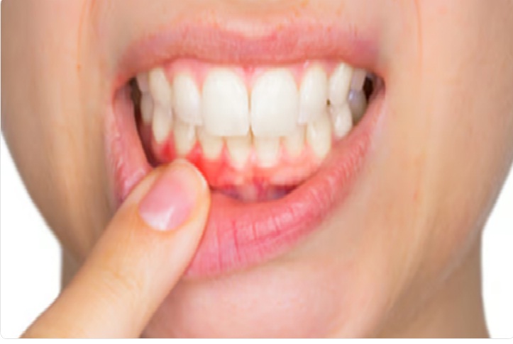 الخضيري: بقاء الأحماض فترة طويلة على الأسنان قد يؤدي إلى تآكل طبقة المينا 9bbd8bdf 4de6 4c58 89c4 75856b718b1c