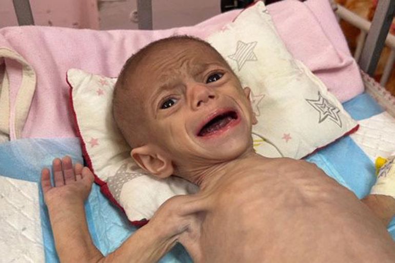 في غزة.. طفولة معذبة تحت سياط الحرب 19 **داخلية** الطفلة سوار عاشور 5 شهور تعاني من سوء التغذية نتيجة لعدم توفر الحليب وانعدام الأدوية والمدعمات اللازمة