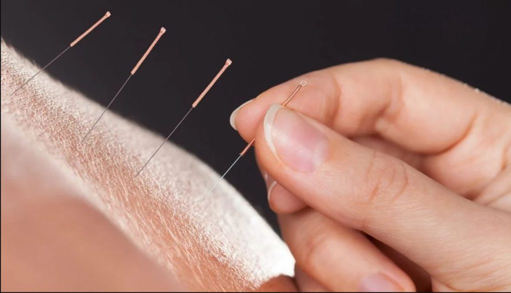 نهاية مأساوية بعد جلسات علاج بالأبر الصينية 1747059990 image