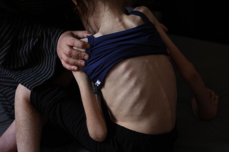 أجساد هزيلة وأعين غائرة.. أطفال غزة أول ضحايا المجاعة 25 Shuruq Ayyad shows off the protruding ribs of her 12-year-old daughter Rahaf at a school-turned-shelter in al-Rimal in central Gaza City on May 4, 2025.