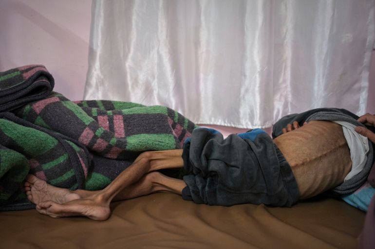 أجساد هزيلة وأعين غائرة.. أطفال غزة أول ضحايا المجاعة 23 Mona al-Raqab lifts the shirt of her 5-year-old son, Osama al-Raqab, revealing signs of malnutrition and worsening cystic fibrosis, exacerbated since the start of the war by the shortage of meat, fish, and enzyme tablets needed to help him digest food, as he receives treatment at the malnutrition clinic in Nasser hospital, Khan Younis, Gaza Strip, Thursday, May 1, 2025(AP Photo/Abdel Kareem Hana)