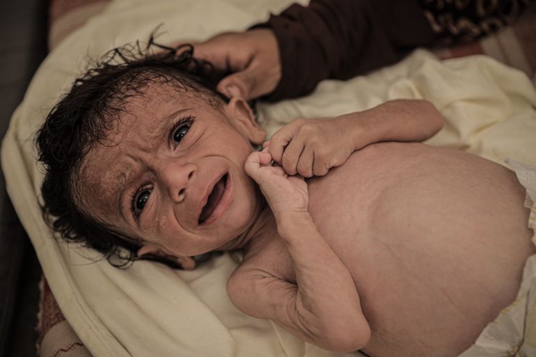 رحلة كيس الطحين.. أب يعود منتصرا من جبهة الجوع 6 GAZA CITY, GAZA - JULY 26: Seven-month-old Salim Mahmoud Awad suffers significant weight loss due to the lack of baby formula and food after being displaced to Gaza City, Gaza with his family, on July 26, 2025. Struggling with malnutrition, the infant's health continues to deteriorate as Israel's strict blockade on the Gaza Strip pose a serious threat to the lives of infants. ( Ahmed Jihad Ibrahim Al-arini - Anadolu Agency )
