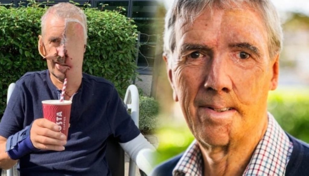 معجزة «NHS»: أول وجه مطبوع ثلاثي الأبعاد لرجل فقد ملامحه في حادثة! 2605977