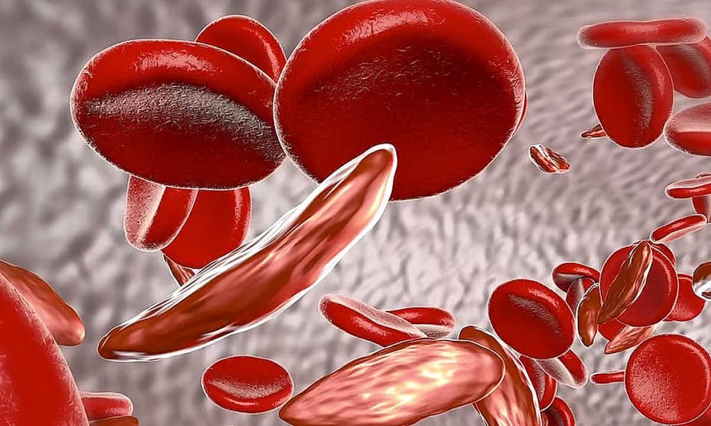 فهد الطبية توضّح أعراض فقر الدم الناتج عن نقص الحديد وعلاجه ajel2F2025 11 022Fz03nrrhj2Fajel2025 10 19n4m8f35xajel2024 071d369534 fabb 45fd 9071 a61b66282f57