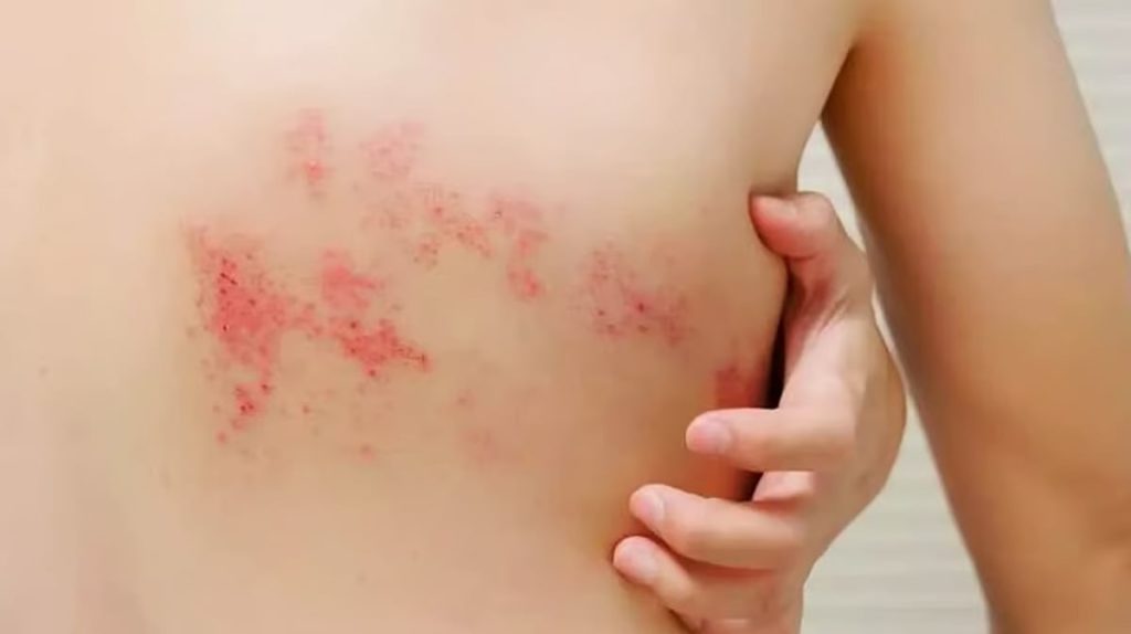 استشاري: التهاب فيروس الحزام الناري يسبب آلامًا شديدة للأعصاب ajel2F2025 11 262Ft1d09kix2Fajel2024 04bf1e42fd dd75 4dbf aad5 f654c1a3dafc760d3589 303b 4be3 8be