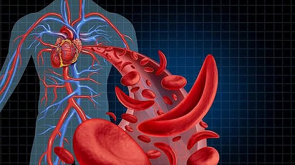 مستشفى الملك عبدالعزيز يوضح أعراض الأنيميا المنجلية ومضاعفاتها ajel2F2025 12 042Fk6ondq4s2Fajel2025 10 06dsrg1f3sajel2025 08 31nndvejeoajel2022 055686db17 d028