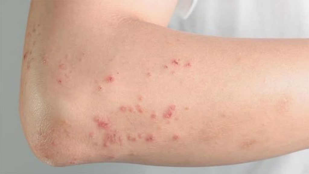 أخصائية: أعراض حساسية الطعام قد تظهر فجأة بدون مقدمات ajel2F2025 12 182F4dkdf4r12Fajel2022 010691ad94 0401 43ea bc03 31993e2d38ae9afd379b 6a25 47b0 821