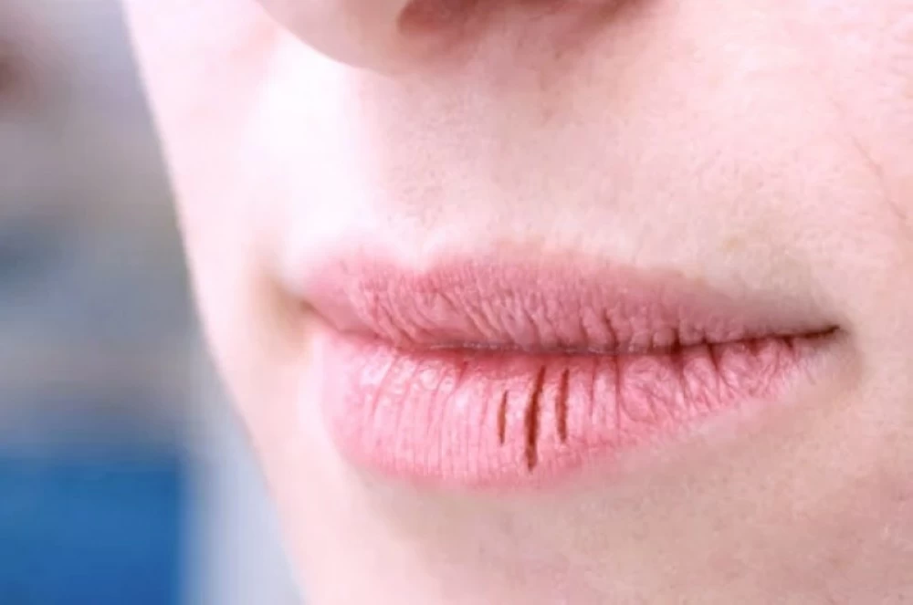 تشقق الشفاه.. مؤشر اضطرابات صحية – أخبار السعودية 2650373.webp